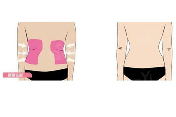 记录我腰腹环吸术后恢复全过程，当天就能看到腰围变小！