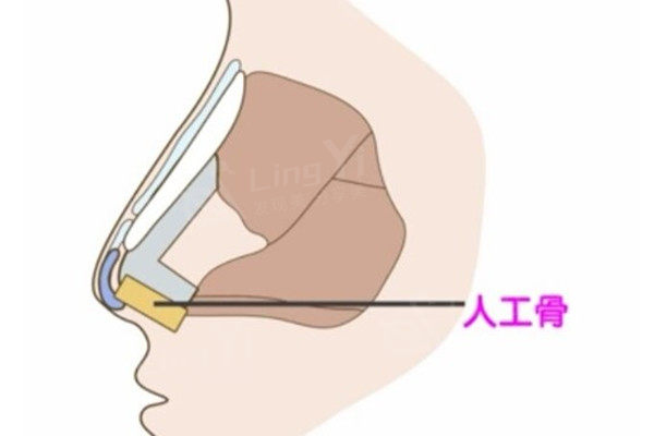 自体软骨隆鼻