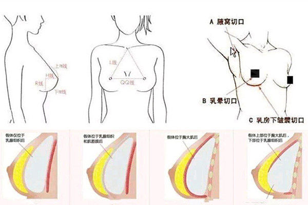 假体隆胸切口在什么位置比较好？腋下/乳晕/胸下切口有什么优缺点