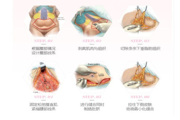 什么是腹壁整形术