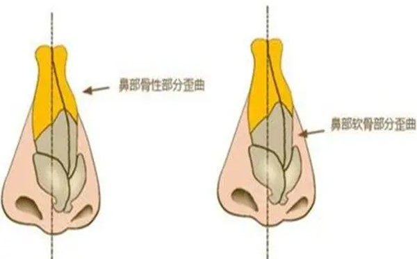 鼻梁歪斜