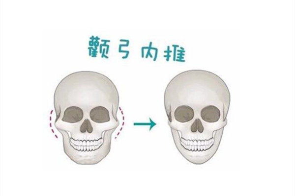 上海颧骨内推做得好的医院推荐，排名前五技术高价格也不贵