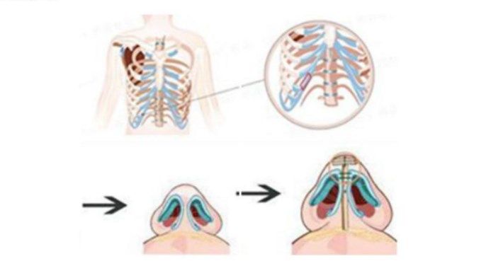 肋软骨隆鼻
