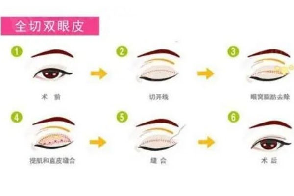 全切双眼皮手术过程