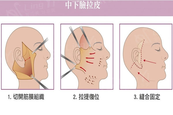 中下脸拉皮手术示意图