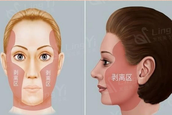 拉皮手术剥离区域示意图