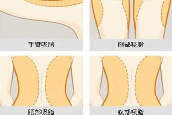 吸脂部位