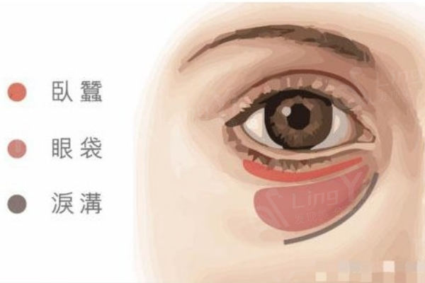 如何不留痕迹地切除眼袋让你看起来更年轻？这些祛眼袋方法了解下!
