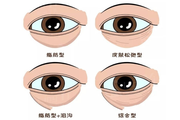 眼袋的类型