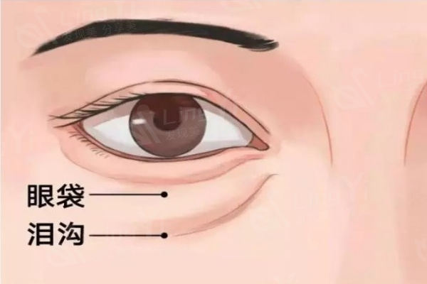 眼袋大