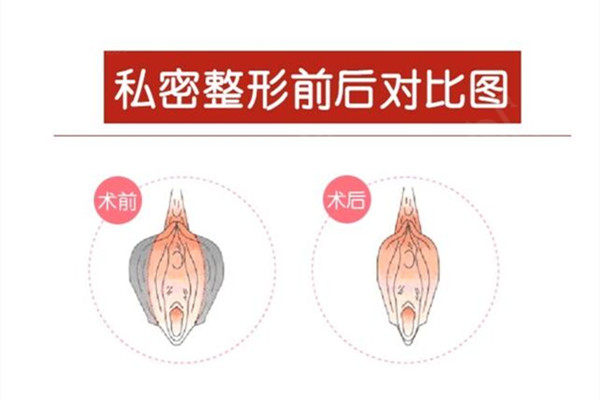 上海私密整形手术哪家好？排名前五的医院价格合理缩阴满意度高