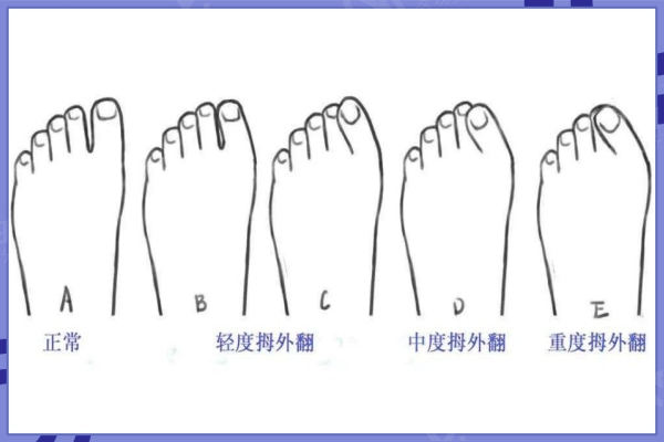 拇外翻不同程度照片