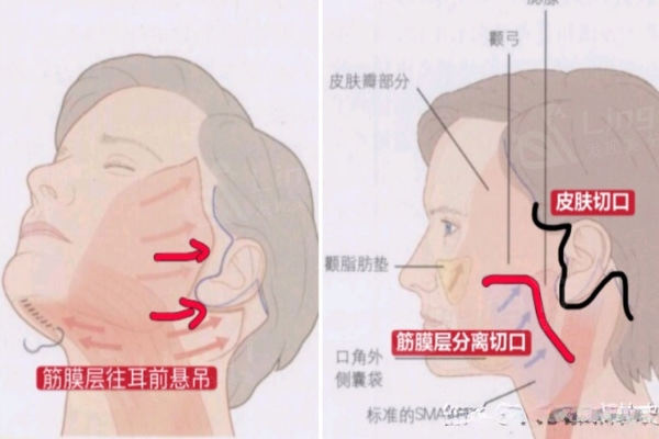 SMAS筋膜层拉皮提升