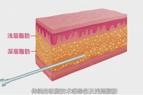 西安抽脂医院哪家好