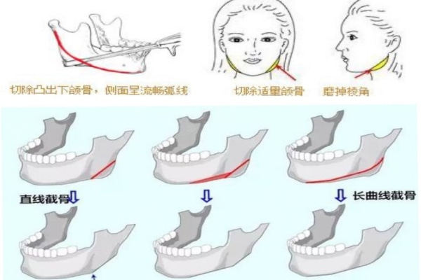 磨骨手术