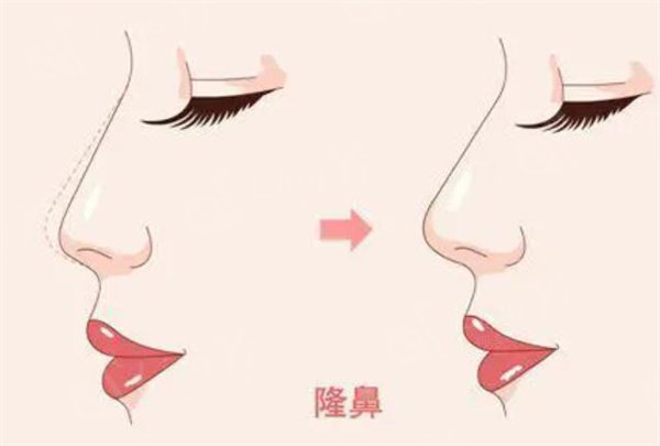 北京白志鹏做鼻子怎么样