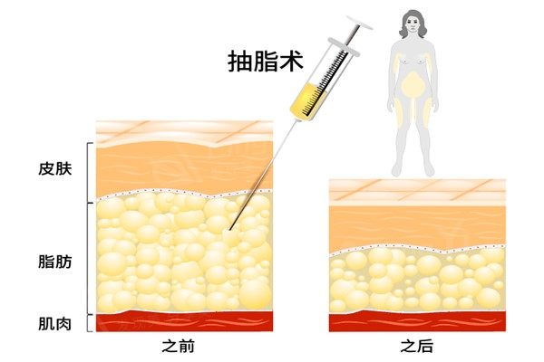 吸脂手术