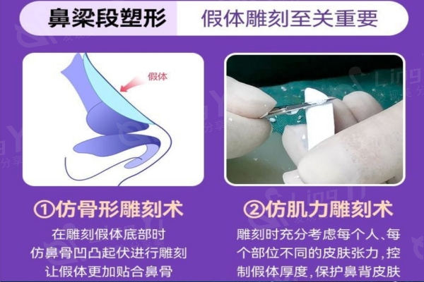 假体隆鼻的技术关键：雕刻实力