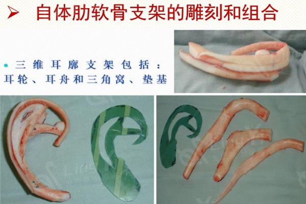 自体软骨造耳
