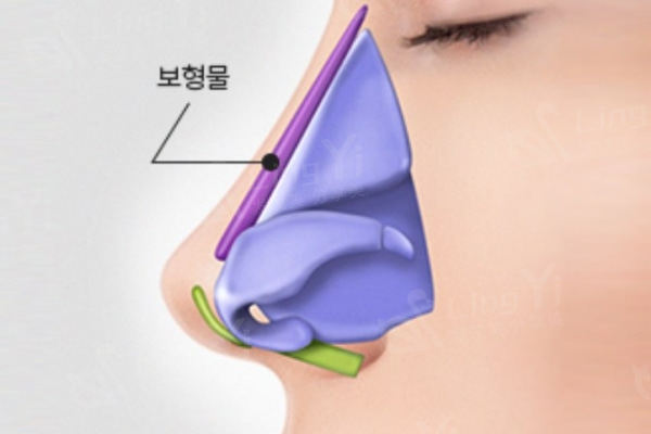 韩国隆鼻手术