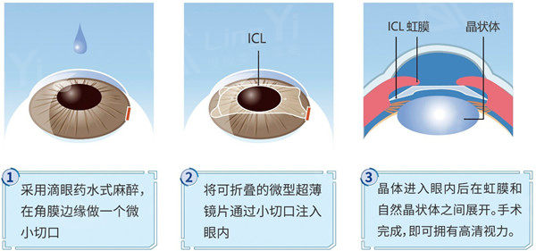 南京市激光近视眼手术费用