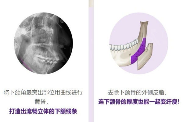 韩国ID整形的双腭手术