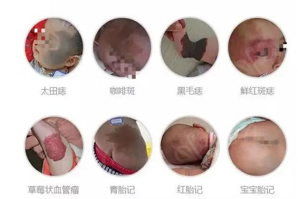 胎记种类