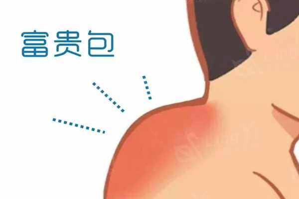上海去富贵包哪个医院技术好较好？华美、薇琳、 上榜前三