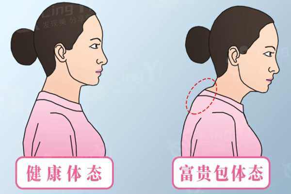 广州治疗富贵包哪家医院好，富贵包微创手术好的医院是谁
