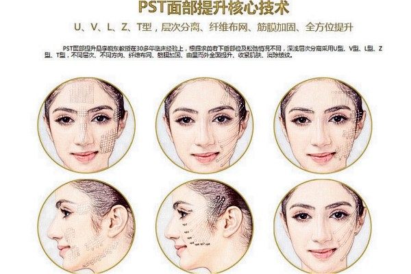 PST拉皮技术