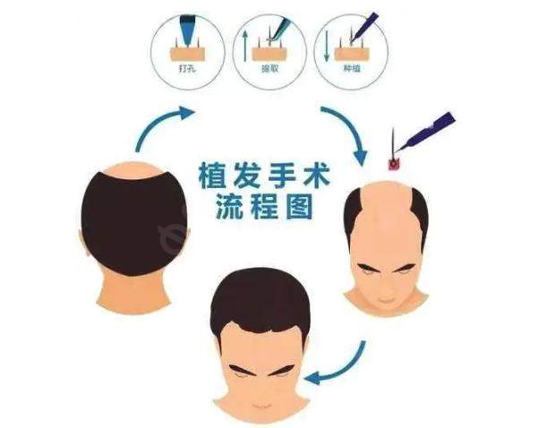 北京植发价格