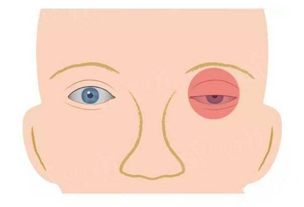 眼痉挛是怎么引起的？眼睑痉挛可以自愈吗？
