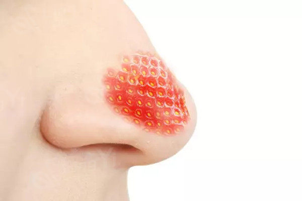 草莓鼻子
