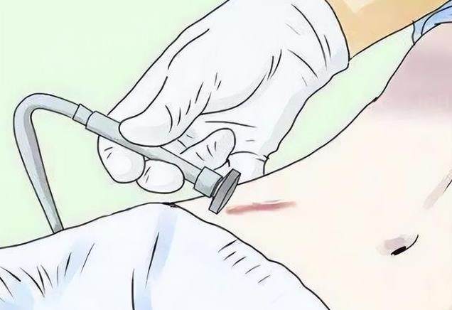成都疤研疤痕医院祛疤痕贵吗