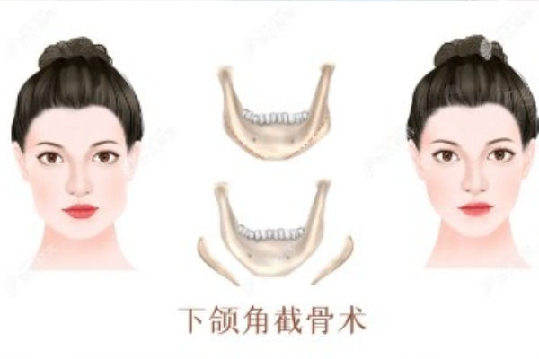 下颌骨截骨术