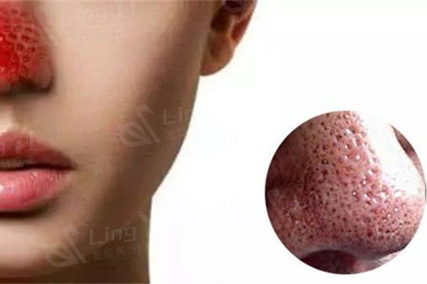 草莓鼻子怎么修复？光子嫩肤或果酸换肤来进行修复