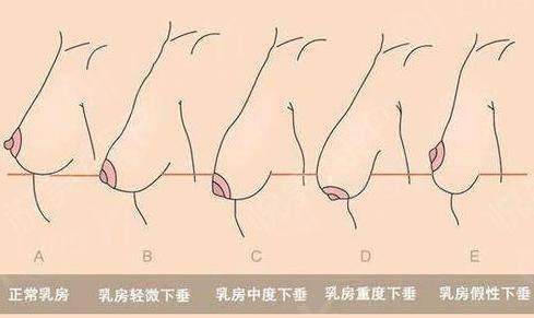 乳房下垂矫正