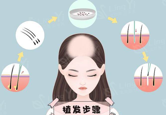 重庆植发哪家强
