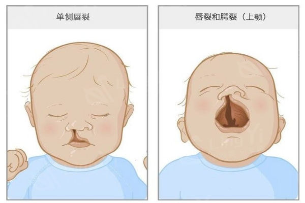 河南儿童唇裂修复哪家医院好?郑州中医药大学一附院技术口碑排名前列值得选