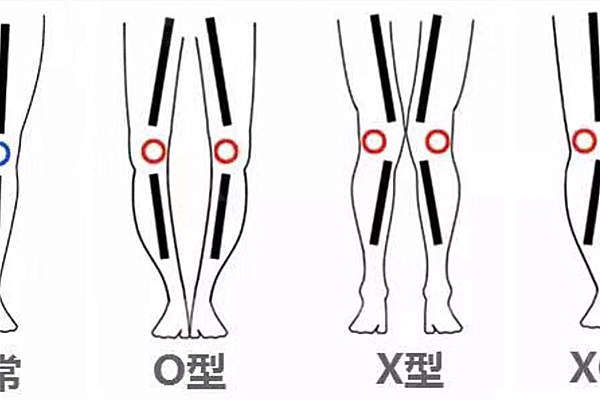xo型腿矫正手术好风险不大的医院排名：达美如艺/恒博天姿上榜