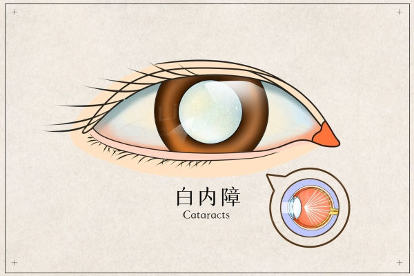 河南白内障手术哪家医院好?博爱/尖峰/普瑞上榜眼科医院前三可医保