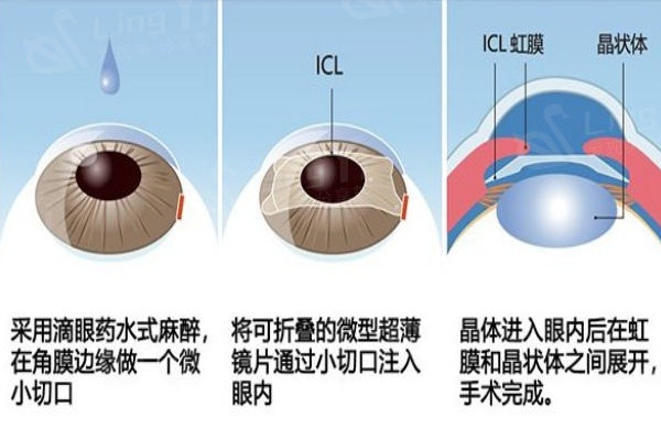 深圳晶体植入手术多少钱?ICL近视手术28000+白内障晶体植入9000+