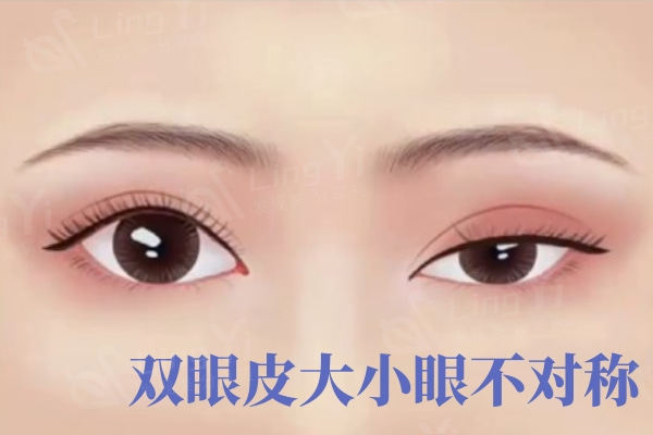 沈国雄双眼皮修复怎么样?对比上海眼修复医生杜园园、徐晓斐技术便知谁的技术好?