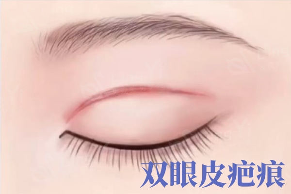 双眼皮术后疤痕