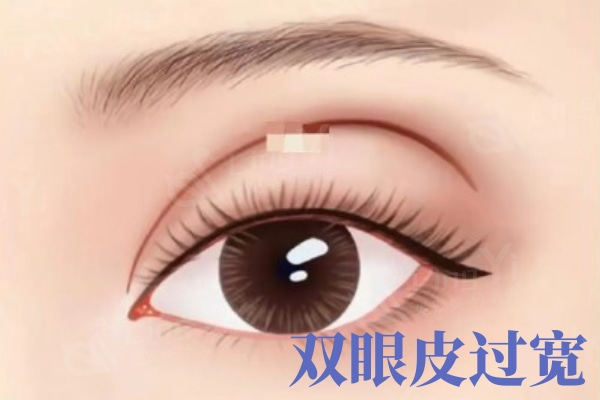 割双眼皮过宽