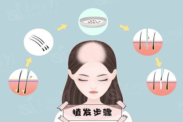 韩国植发价格大概多少钱