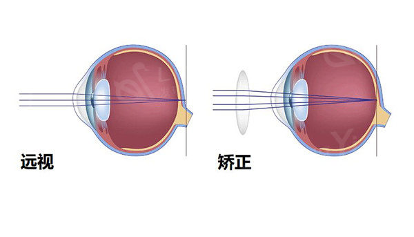 近视手术