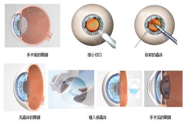 沈阳爱尔眼科