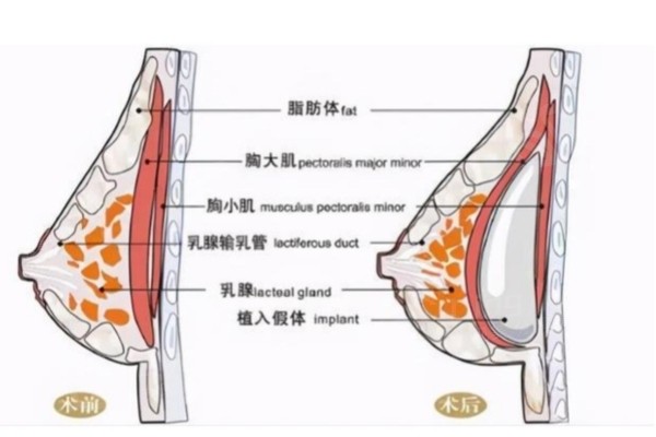 沈阳哪里隆胸比较好？这五家医院丰胸技术靠谱价格也划算