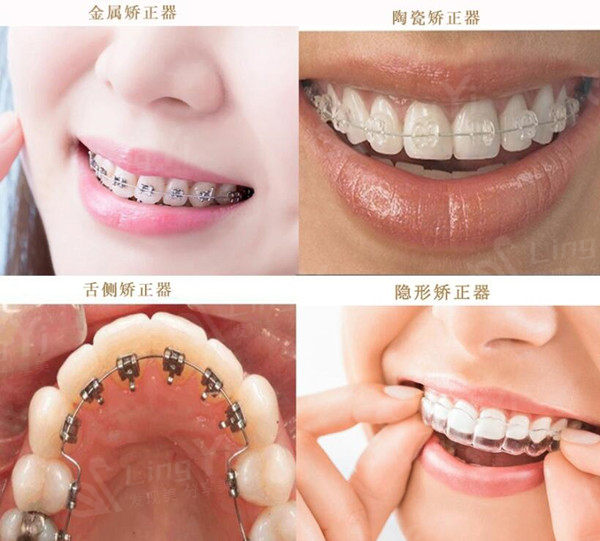 上海雅悦口腔医院收费标准:种植牙3680+正畸6000+价格实惠